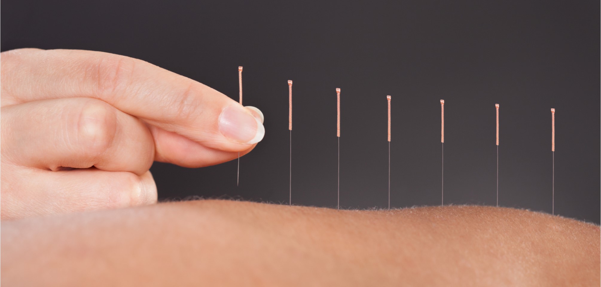 close up of a hand placing acupuncture needles along someones back
